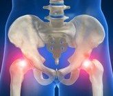 Эффективное лечение артрита тазобедренного сустава