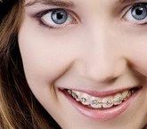 Основные этапы лечения брекет-системами